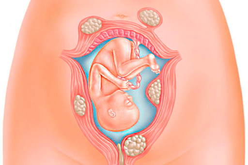 U xơ tử cung có thể ảnh hưởng đến khả năng mang thai và sinh con của nữ giới